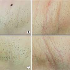 This makes hair removal less painful and easier. Axillary Hair Before Treatment Left A And Right C Sides Of The Download Scientific Diagram