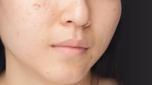 Here you may to know how to correct dark spots on face. Can You Get Rid Of Dark Spots L Oreal Paris