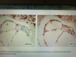 Psammoma bodies possible loss of bap1 or mtap expression or homozygous deletion of cdkn2a helpful in establishing the diagnosis of malignant pleural mesothelioma see below. Tania Labiano On Twitter Great Summary Of New Mesothelial Markers Bap1 Mtap Nuclear Loss W Internal Positive Control In Inflammatory Cells And P16 Loss By Fish Molcytopath20 Thanks Dr Schmitt Cytopath