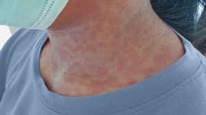 Advise women who receive live vaccines to avoid pregnancy within 28 days of vaccination. Rubella German Measles Symptoms Treatment During Pregnancy