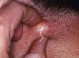 Bartholin's gland cysts and abscesses are commonly found in women of reproductive age, developing in approximately 2% of all women. Sebaceous Cysts Harvard Health