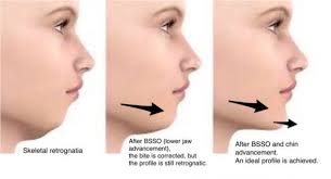 Pin On Chin Surgery Mentoplasty