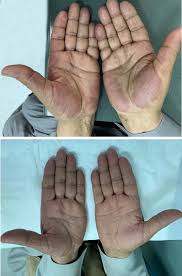 Palmar erythema can be defined as the reddening of the palmar surface of the hand, more specifically of the thenar and hypothenar eminence. Atypical Palmar Involvement With Erythema Elevatum Diutinum As A Sole Ccid