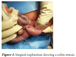 Image result for Intestinal Atresia