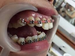 Check spelling or type a new query. Harmful Effects Of Diy Fake Braces Youtube