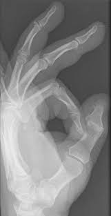 Image result for Lateral PIP Dislocation