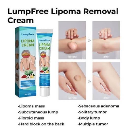 Lipoma Removal Herbal Cream