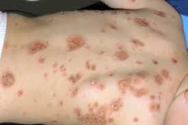 Image result for Impetigo
