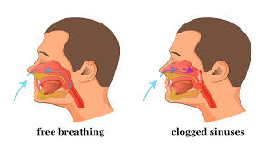 Let the fumes caress your nostrils. A Simple Life Hack To Clear A Stuffed Nose And Clogged Sinus In Seconds During The Polar Vortex 2019