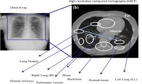 The hepatic flexure and the. Representation Of Chest X Ray To High Resolution Computer Tomography Download Scientific Diagram