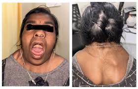 Image result for Webbed Neck