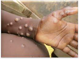 In the biomedical & life sciences collection, henry. Monkeypox