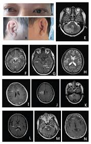 Image result for Relapsing Polychondritis