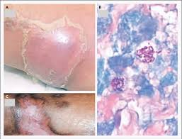 Clinical and Histologic Features of Leprosy. Edematous, tender skin...