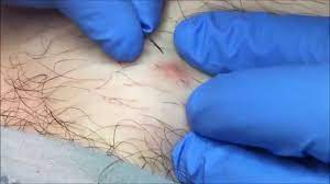 When pulled out or cut extremely close to the skin, the blunt edges of the follicle sometimes curl under. Ingrown Hair Removal On Man S Leg Youtube