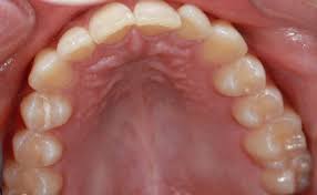 I have been told by my dentist that i have road tracks or signs of grinding and clenching. Why Have My Teeth Moved