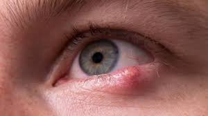Insbesondere wenn weitere beschwerden bestehen, kann die augenrötung das symptom. Gerstenkorn Und Hagelkorn Augenlidentzundung Gesund Bund De