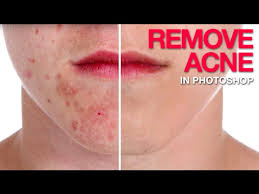 Instead, it uses advanced imaging algorithms to blend the source data into the healed area providing seamless, realistic image repairs. How To Remove Acne In Photoshop Youtube
