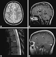 In ms, the immune system attacks the protective sheath (myelin) that covers nerve fibers and causes communication problems between your brain and the rest of your body. Diagnosis Of Multiple Sclerosis An Overview Sciencedirect Topics