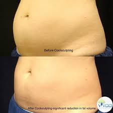 We're spilling all the details: Coolsculpting Treatment In Bellevue And Issaquah Wa Vivaa