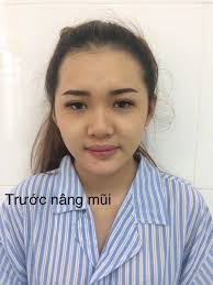 ☀️ Đây là hình ảnh khách của Vivian Beauty VIỆN THẨM MỸ đã  #Nâng_mũi_cấu_trúc_Lline. 🌨🌨 Khách lành da mát thịt nên mũi lên form  chuẩn đẹp Cao Tây 🧐 Theo dõi thêm