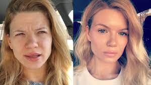 Forehead botox before and after pictures. Botox Before And After Youtube