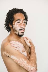 Image result for Vitiligo