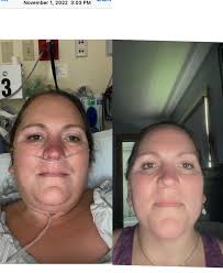 When did you notice weight loss after gastric sleeve surgery?