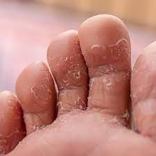 Teruskan langkah i hingga iv di atas sampailah cagu anda tu sembuh. Kulit Di Sela Jari Kaki Bersisik Alergi Atau Kutu Air