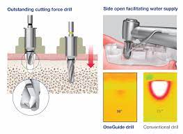 KITS - ONEGUIDE KIT - OSSTEM_WFE