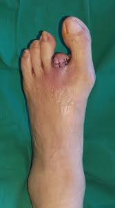 Image result for toe amputation
