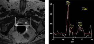 The prostate does not have a true capsule. Diagnosis For Men Prostate Diagnostics