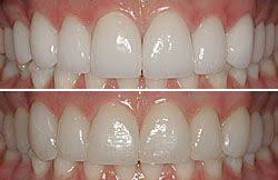 Bl1 Bl3 Tooth Shade Cosmetic Dentistry Porcelain Veneers