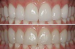 bl1 bl3 tooth shade cosmetic dentistry porcelain veneers