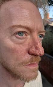 Rhinophyma (Strawberry Nose) Gelatine Prosthetic Used gelatine as the main  material