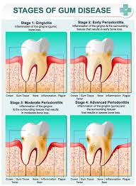 treatment for bleeding gum disease