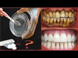 El cigarro es uno de los peores causantes de poner los dientes amarillos, además que no es nada bueno para su salud. Blanqueador Dental Magico Blanquea Tus Dientes En Casa En Tan Solo 5 Minutos Blanqueador Dental Blanqueamiento De Dientes Blanqueamiento Natural De Dientes