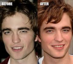 robert-pattinson-before-and-after-plastic-surgery