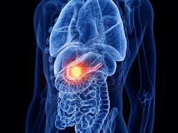 There aren't any noticeable what is the prognosis for pancreatic cancer? Advances In Pancreatic Cancer Research And Treatment Rutgers Cancer Institute Of New Jersey
