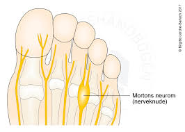 Symptomer kan oppstå i et annet område enn der nerven kommer i klem så det er viktig å vite hvordan å gjenkjenne en klemt nerve. Mortons Metatarsalgi Patienthandbogen Pa Sundhed Dk