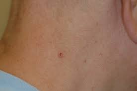 These changes are the result of the interaction between a person's genetic factors and three categories of. Disease Management Nonmelanoma Skin Cancer
