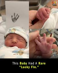 Did - A newborn named Ronan is touching hearts online after a photo  highlighted his “Lucky Fin,” a rare limb difference called symbrachydactyly  that affects about 1 in every 30,000 to 40,000