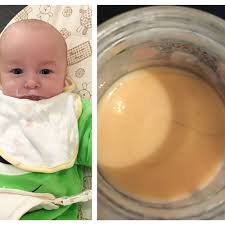 Chances are the hair loss is normal, but his doctor can make sure that there isn't an underlying medical condition and help with treatment if there happens to be a problem. My Baby Could Have Choked To Death On Pubic Hair Horrified Mum Claims Five Month Old Tot S Custard Pudding Was Full Of Strands Daily Record