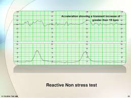 A nonstress test (nst) is a screening test used in pregnancy. Pregnancy Stress Test Results Pregnancywalls