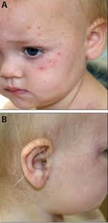 Capillaries are the tiniest blood vessels that connect arteries to veins. Figure 8 From Petechiae And Purpura The Ominous And The Not So Obvious Semantic Scholar