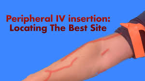 Image result for Peripheral IV Access