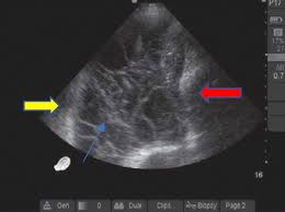Maybe you would like to learn more about one of these? Update In The Management Of Pleural Effusions Medical Clinics