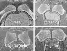 Image result for Pubic Apophysitis