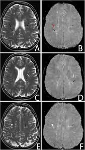 Haga clic en los términos sugeridos que aparecen debajo del buscador. Detection Of Central Veins Using Susceptibility Weighted Imaging Swi For Discrimination Between Lesions In Multiple Sclerosis Ms And Cerebral Small Vessel Disease Csvd Egyptian Journal Of Radiology And Nuclear Medicine