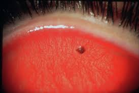 Image result for Eye Foreign Body